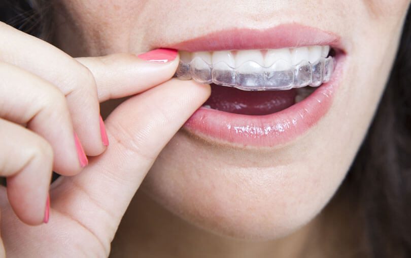 Tips for Getting the Most Out of Your Invisalign Treatment