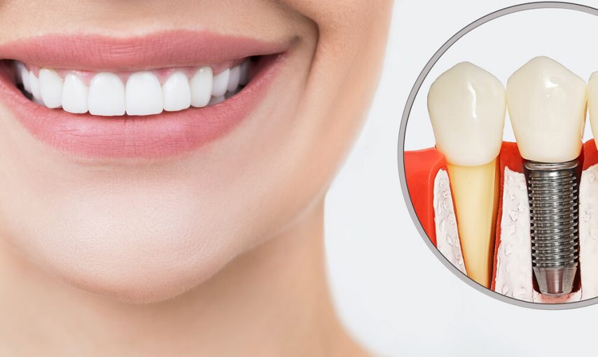 All You Need To Know About Dental Implants
