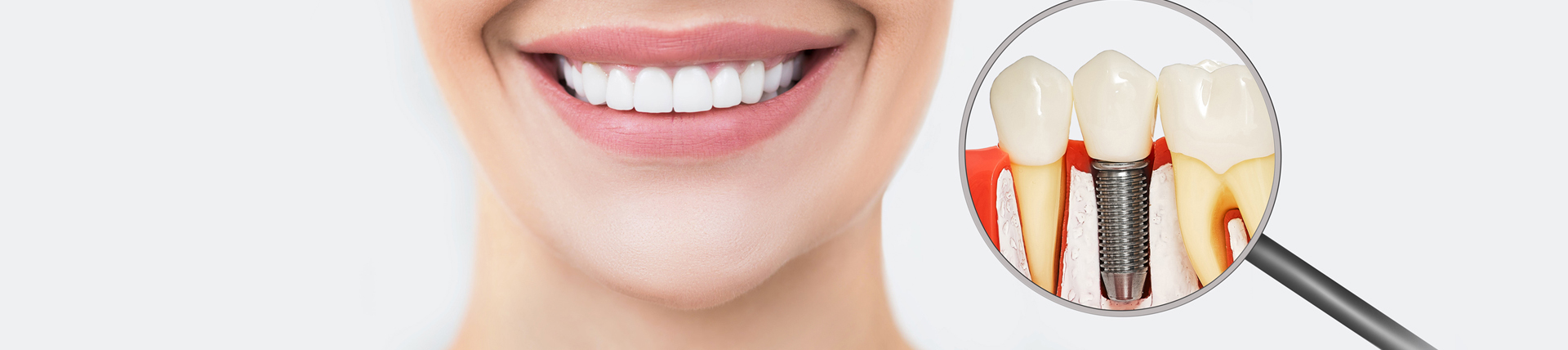 Dental Implants