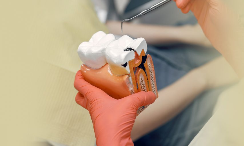 What Materials Are Used to Make Dental Sealants?