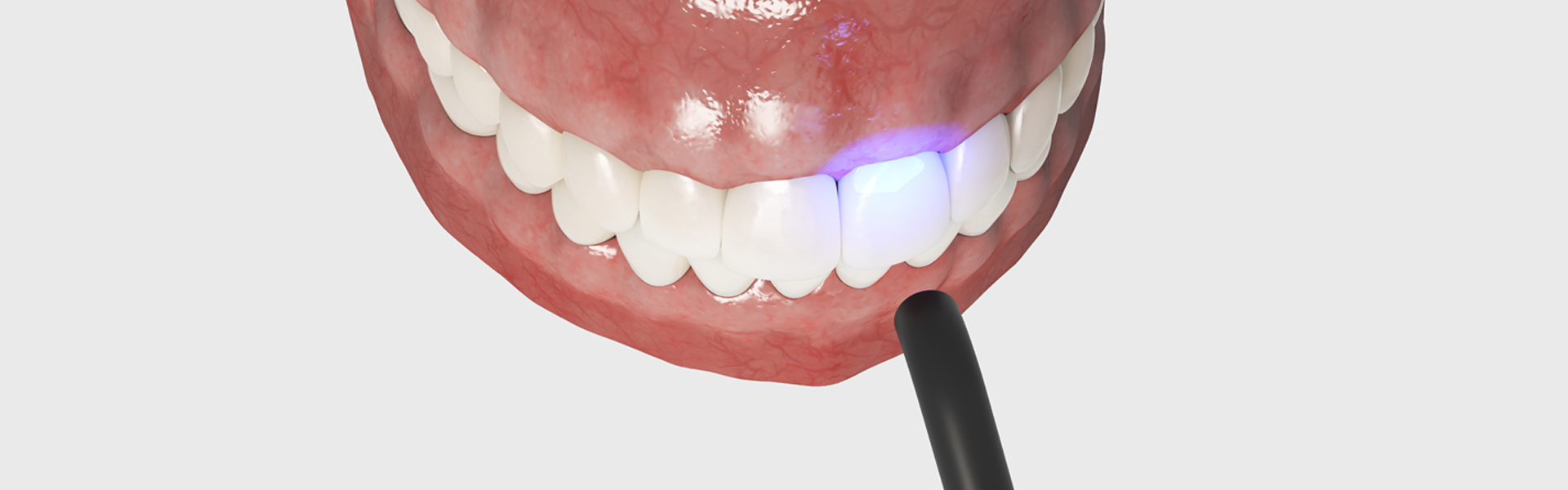 Can tooth bonding help receding gums?
