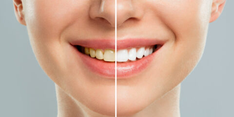 Teeth Whitening