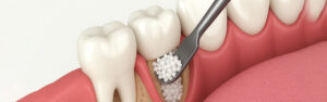 How do I know if my bone graft is healing properly
