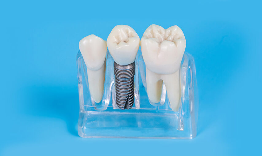 Top Myths About Dental Implants Debunked