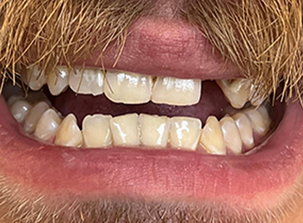 After-Munsterone