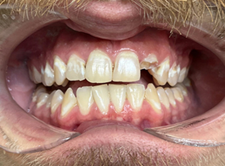 Before-Munsterone