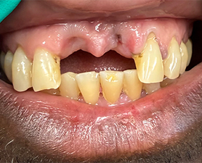 Before-Patient 11