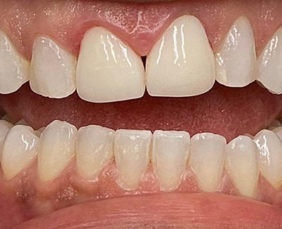 Before-before after