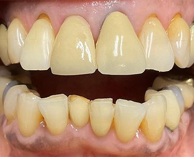 After-before after
