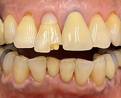 Before-before after