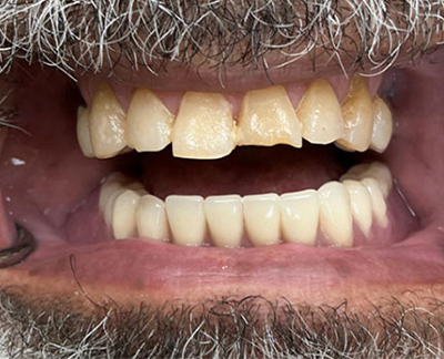 Before-before after
