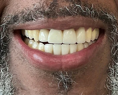 After-Before After