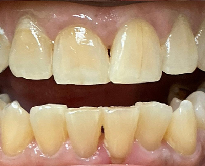 After-before-after
